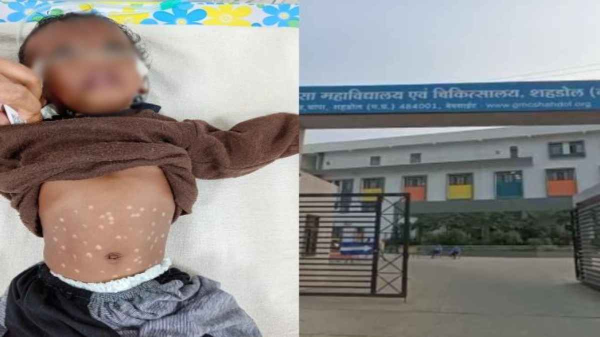 MP में 3 माह की बच्ची पर बेइंतहा कहर: दूधमुंही बच्ची को 51 बार गर्म सलाखों से दागा, मेडिकल कॉलेज में भर्ती, हालत नाजुक
