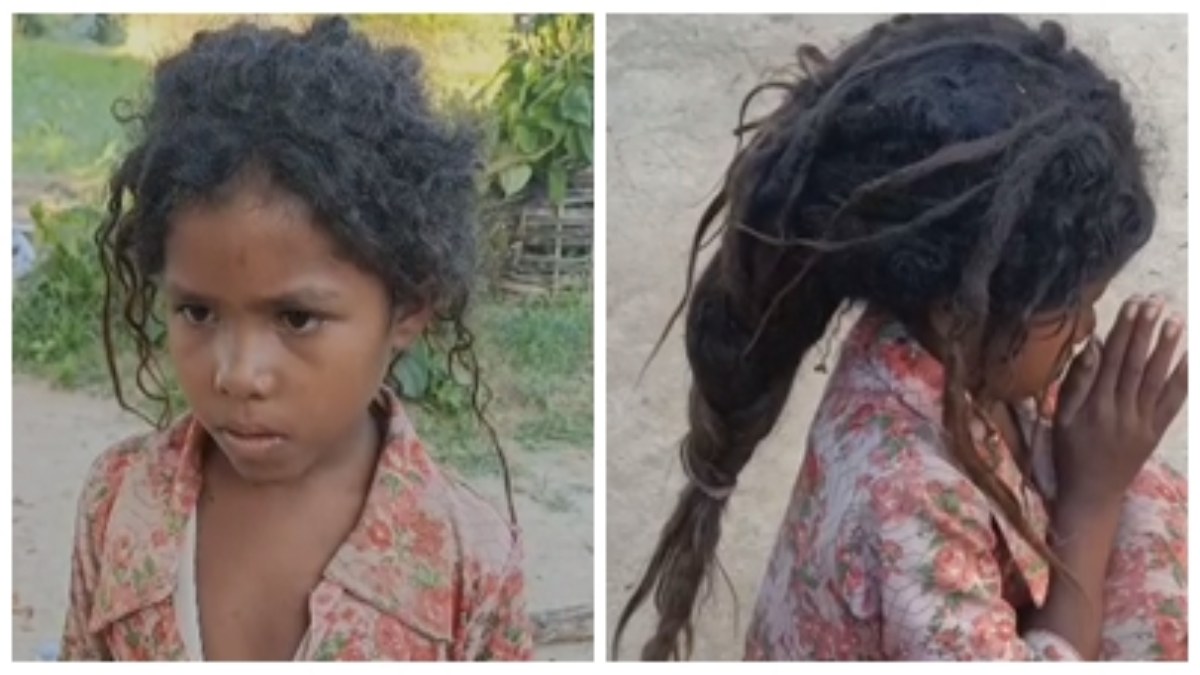 अंधविश्वास! 7 साल की मासूम को बना दिया भगवान, इंफेक्शन के कारण सिर पर हैं नारियल के जटा जैसे बाल, परिवार ने नहीं कराया इलाज  