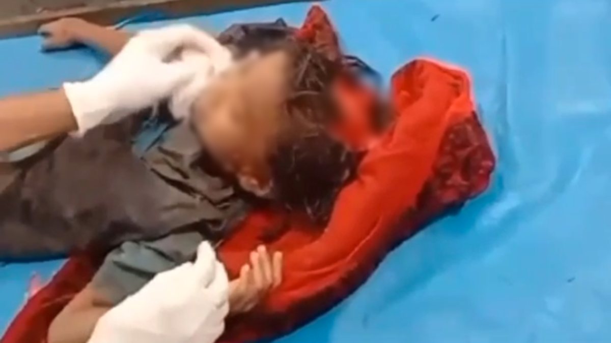 सिवनी में आवारा कुत्तों का आतंक: स्कूल जा रही पांच साल की मासूम बच्ची को नोचा, गंभीर हालत में अस्पताल में भर्ती