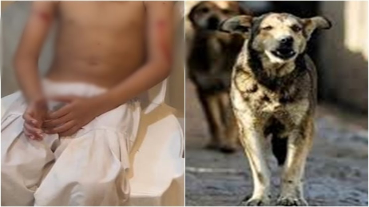 Dog Bite: भोपाल में नहीं थम रहा आवारा कुत्तों का आतंक, मासूम को फिर बनाया शिकार