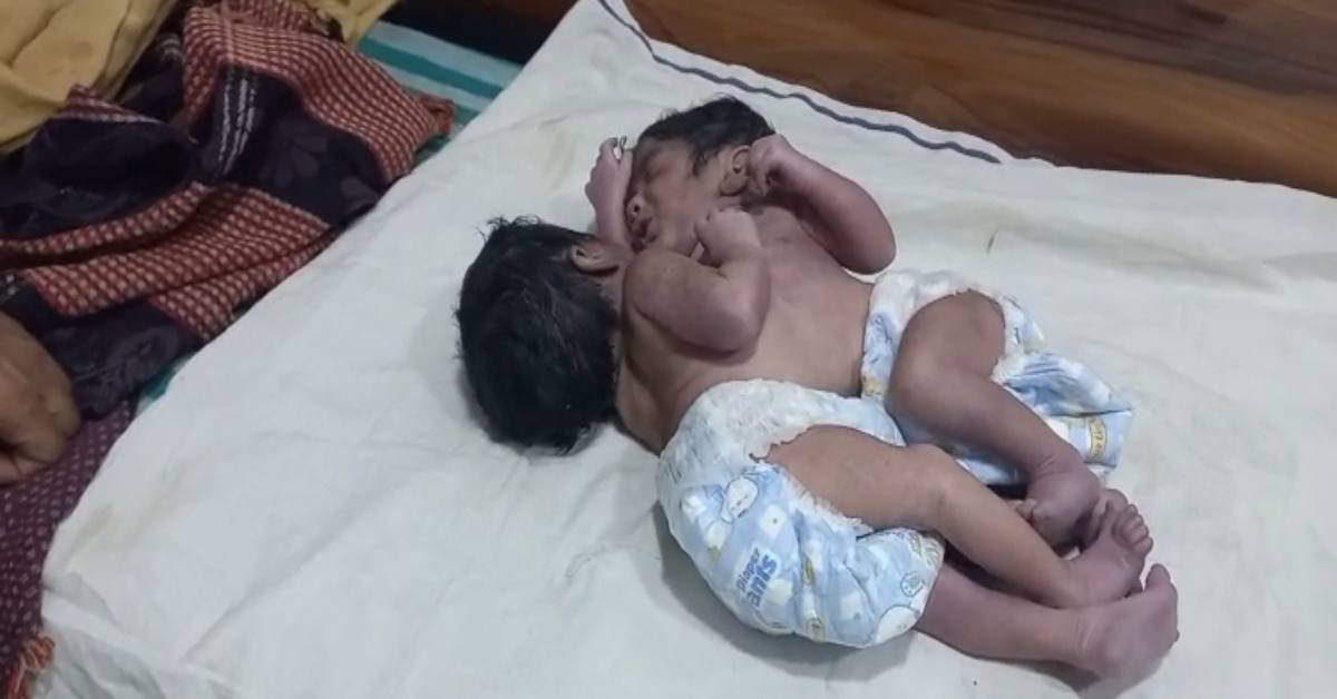 महिला ने दिया अद्भुत बच्चों को जन्म, शरीर से जुड़े हैं दोनों मासूम महिला ने दिया अद्भुत बच्चों को जन्म, शरीर से जुड़े हैं दोनों मासूम