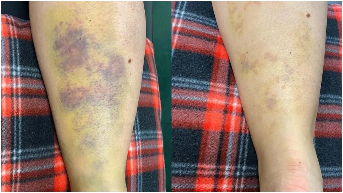 आपकी Body में भी बिना चोट के अचानक दिखने लगता है नीला-काला निशान, तो हो सकता है गंभीर संकेत …