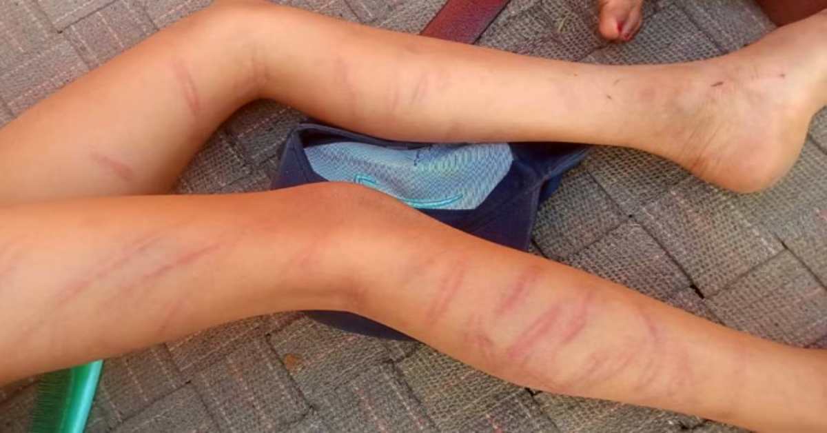 शिक्षक है या शैतान! बेरहम टीचर ने 9 साल के छात्र पर बरसाए 105 डंडे, पैर और शरीर पर जुल्म के निशान