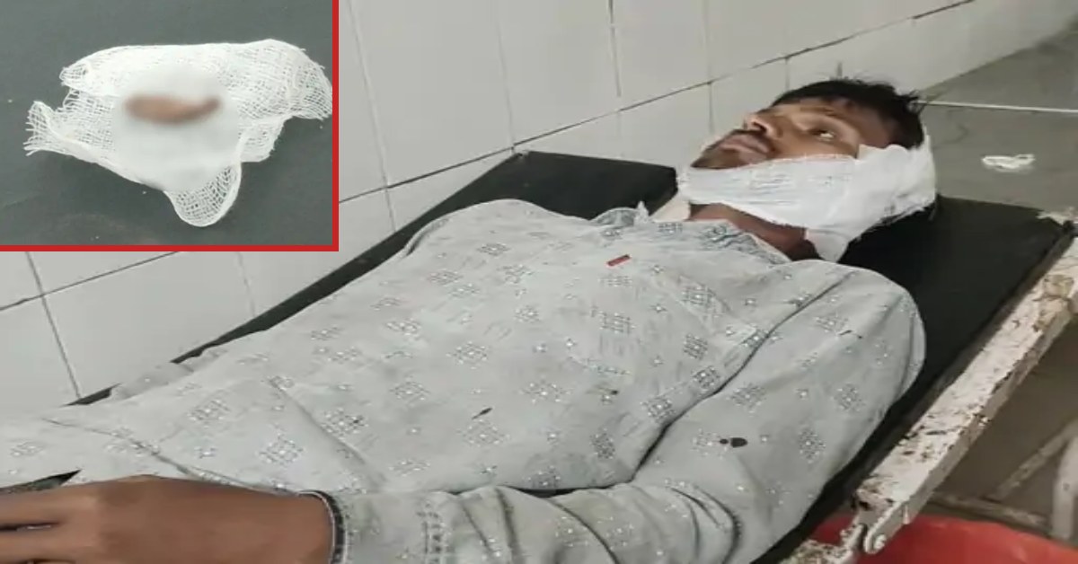 कटा हुआ कान लेकर पुलिस थाने पहुंचा शख्स : मामूली विवाद में नशेड़ी ने दांत से काट लिया युवक का कान, खून से हुआ लथपथ