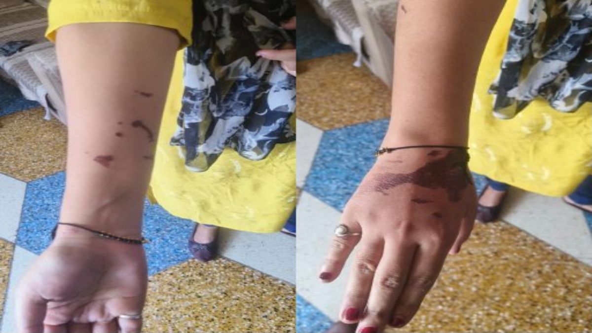 नशे में चूर पति ने पत्नी पर किया एसिड अटैकः 4 माह की बेटी और ससुर भी झुलसे, पति के खिलाफ मामला दर्ज