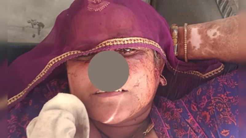 Rajasthan News: सांचौर में रिश्तों का खूनी खेल: सास से नाराज दामाद ने काटी नाक, कटा हिस्सा लेकर फरार