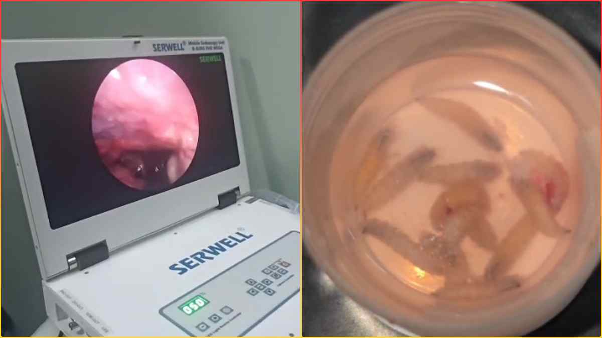 सर्दी-खांसी को किया नजरअंदाज, 14 साल की दिव्यांग की नाक में पनप गए कीड़े, डॉक्टर भी हुए हैरान, देर होती तो दिमाग तक पहुंच जाता संक्रमण