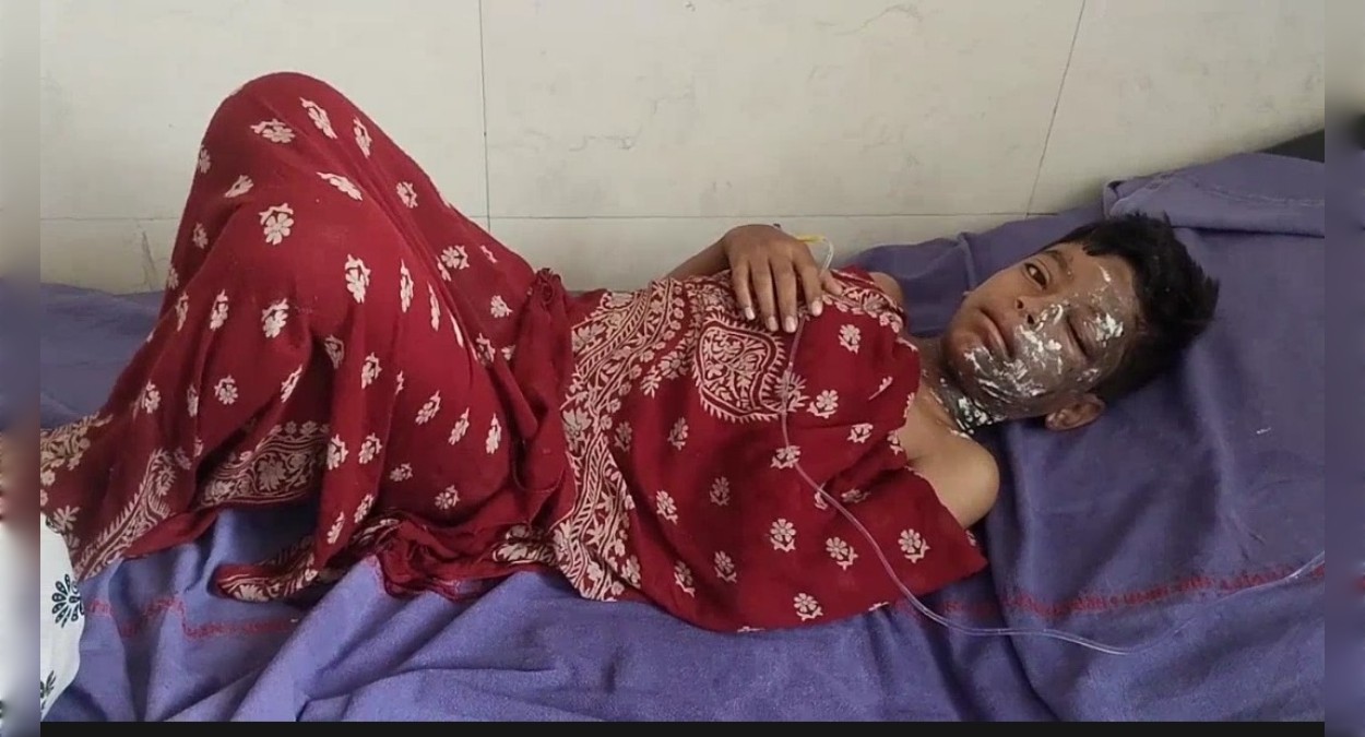 रिहायशी इलाके में फटा ट्रांसफार्मर, घर की छत्त पर खेल रहे बच्चे घायल, इलाज जारी, कई घर भी आये चपेट में