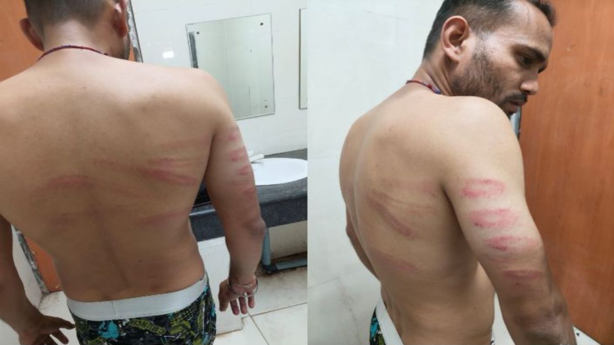 अमरनाथ यात्रा रजिस्ट्रेशन के लिए खड़े व्यक्ति की पिटाईः चौकी ले जाकर की मारपीट, पूरे शरीर पर चोट के निशान