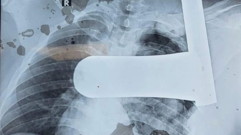 Udaipur News: 9 इंच का पाइप शरीर में घुसा, रोंगटे खड़े कर देने वाली सर्जरी कर बचाई जान