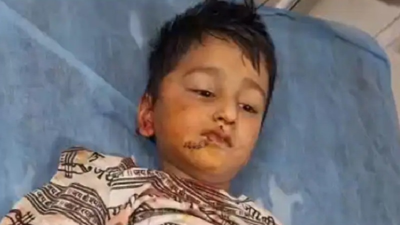 सीकर में रूह कंपा देने वाली वारदात: घर के बाहर खेल रहे 5 साल के बच्चे को कुत्ते ने बुरी तरह नोचा, चेहरे पर आए 15 टांके!