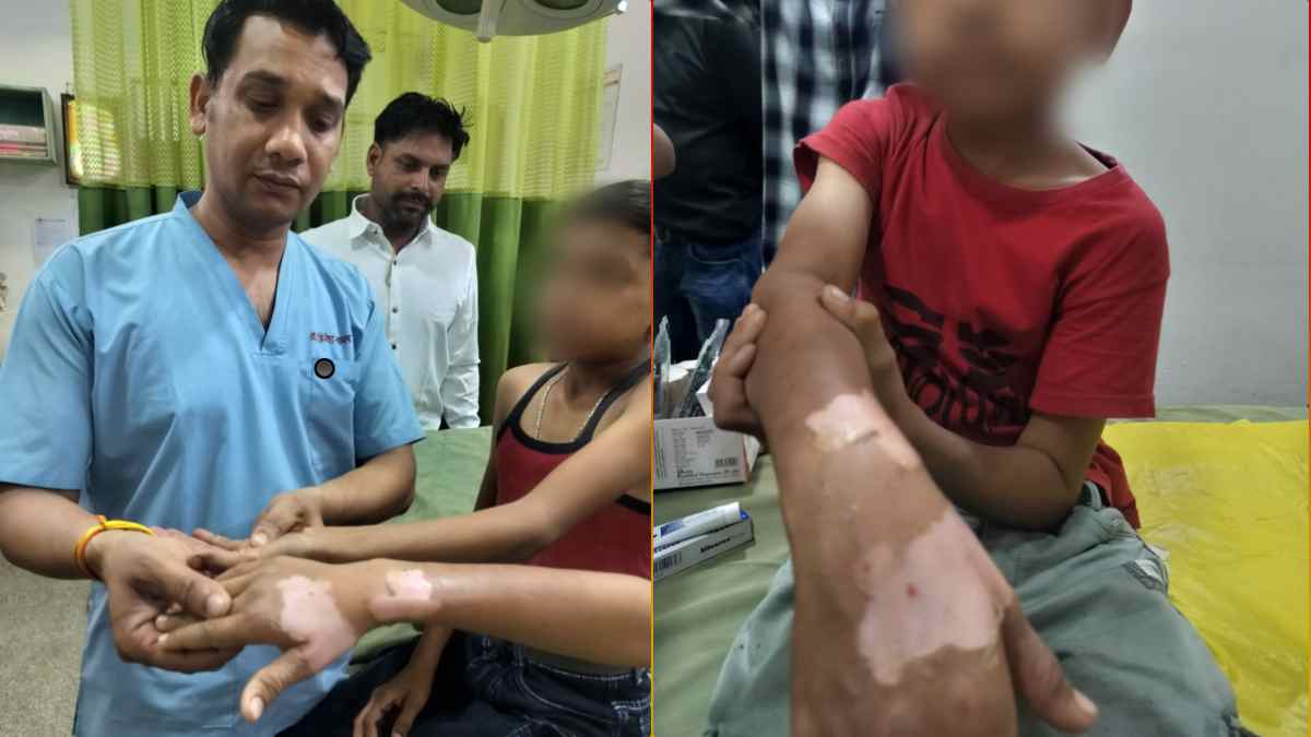 बच्चे की कलाई में बंधा स्मार्ट वॉच फटा: कलाई की चमड़ियां उधड़ी, शादी समारोह में मची अफरा-तफरी