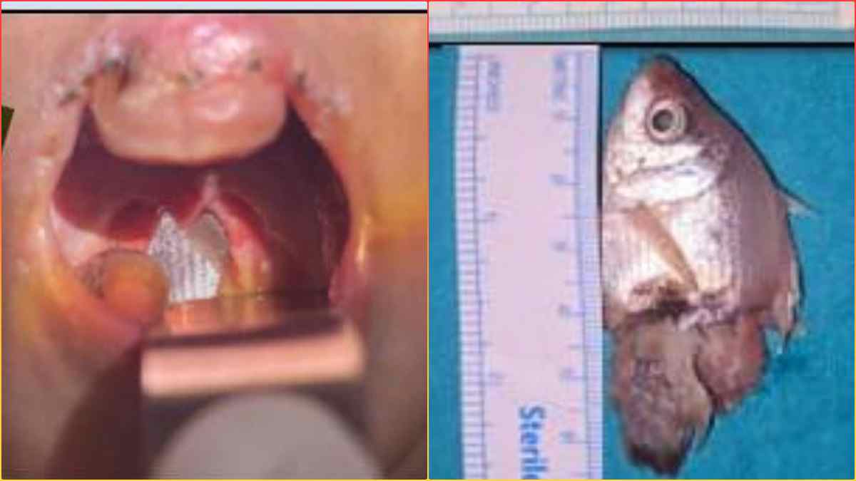 बच्ची के गले में फंसी जिंदा मछली: एक्वेरियम साफ करने के दौरान हुआ हादसा, MY हॉस्पिटल में हुआ सफल इलाज