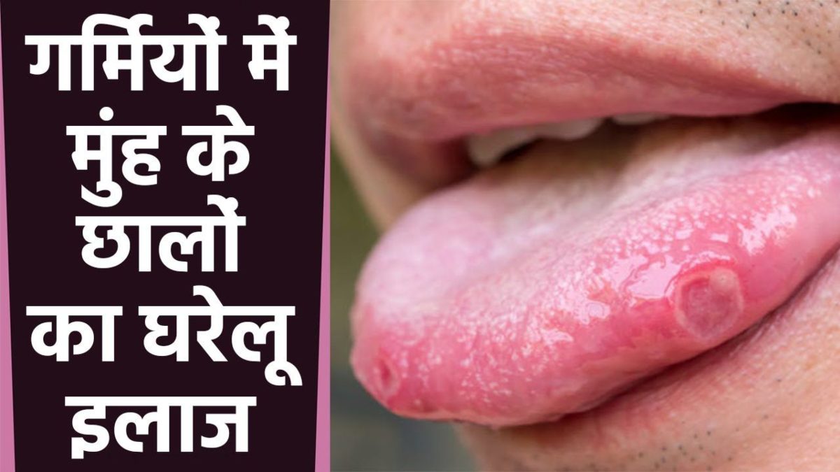 बढ़ती गर्मी में मुंह में हो जाते हैं छाले, यहाँ जाने इससे राहत पाने के घरेलू उपाय …