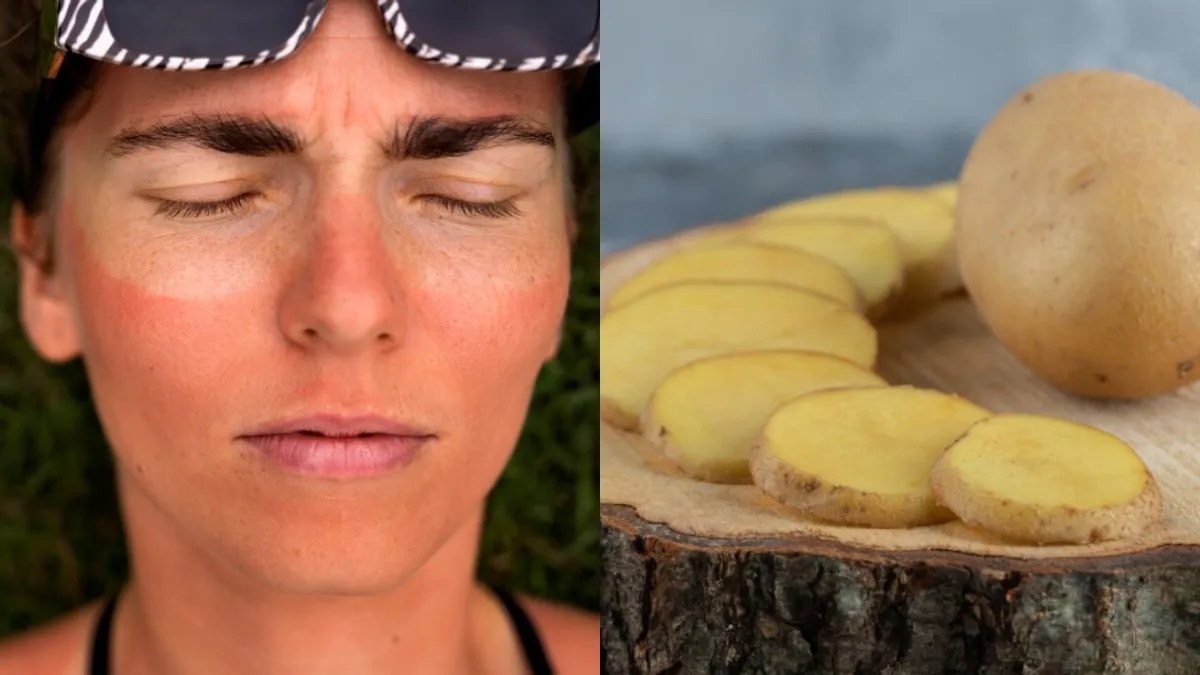 गर्मी के धूप से स्किन हो गई है टैन, तो आलू का रस इस समस्या से देगा राहत …