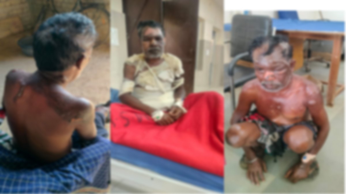 घर में पत्नी बनाती थी शराब, पति ने किया मना तो उड़ेल दिया गर्म पानी, जिंदगी और मौत के बीच जूझ रहा शख्स
