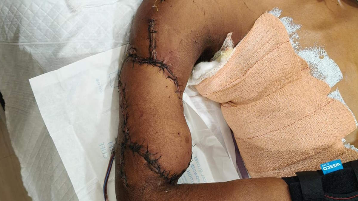श्री नारायणा हॉस्पिटल के प्लास्टिक सर्जन और ऑर्थोपेडिक टीम का कमाल, युवक की बांह कटने से बचाई
