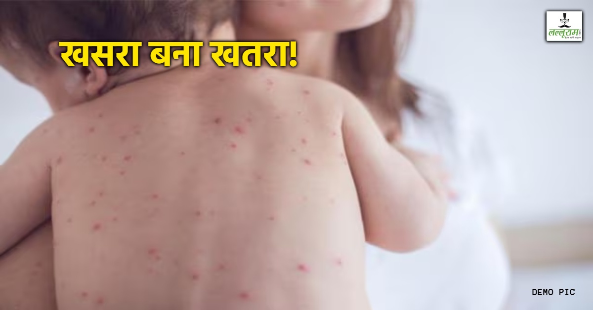 ग्वालियर में मीजल्स की दस्तक: अस्पताल में आठ बच्चे भर्ती, एक की रिपोर्ट पॉजिटिव; जानें क्या है इस बीमारी के लक्षण