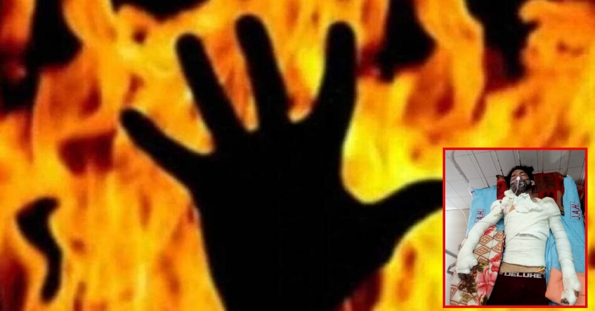 पेट्रोल के दाम पर विवाद के बाद युवक को जिंदा जलाने की कोशिश, 37% झुलसा, बचाने आया एटीएम गार्ड भी घायल