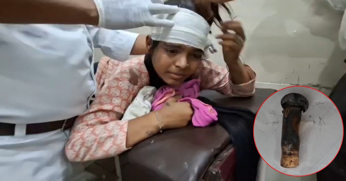 ‘सिर में घुसी थी 1 इंच की गोली, लड़की समझती रही साधारण सिरदर्द!’ शासकीय अस्पताल के डॉक्टरों का चमत्कारी कारनामा