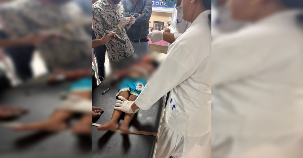 आवारा कुत्ते ने 3 साल की बच्ची को नोचा: चेहरे पर लगे 55 टांके, गंभीर हालत में आगर से इंदौर रेफर