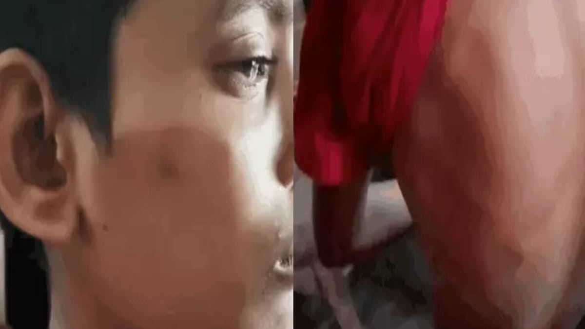बेतिया में छात्र की बेरहमी से पिटाई, मामूली बात पर शिक्षक ने पीटा, परिजनों का हंगामा