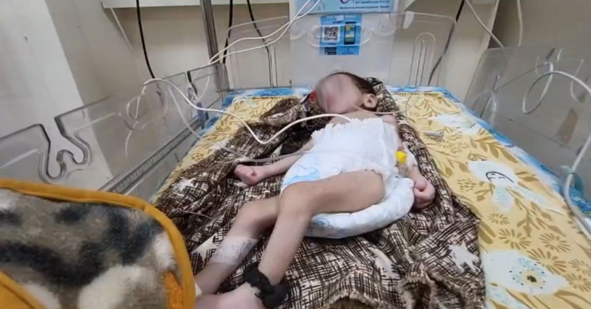 शिवपुरी में कुपोषण खत्म करने के दावे फेल: 1476 बच्चे अति कुपोषित, 92 नए केस मिले