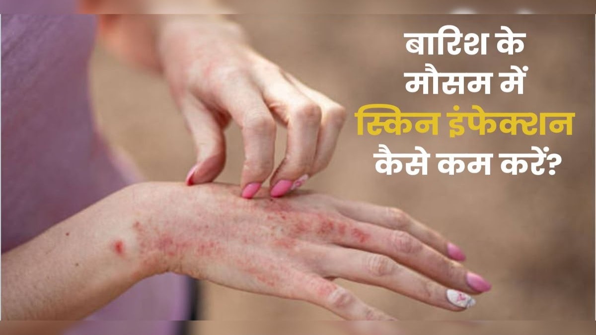 बारिश में भीगने के बाद भूलकर भी न करें ये गलती, नहीं तो बढ़ सकता है स्किन इंफेक्शन का खतरा …