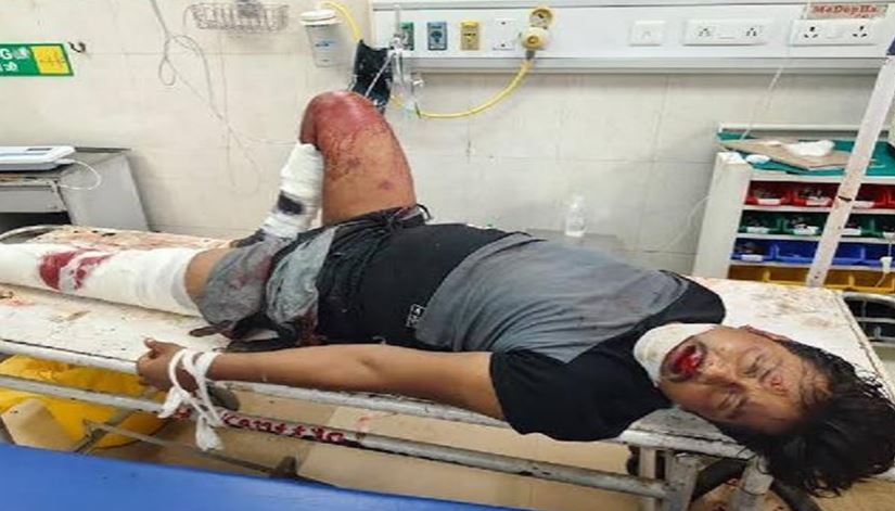 पत्नी के मायके जाने से नाराज युवक ट्रक के सामने कूदा, दोनों टांगें टूटीं