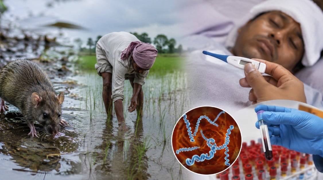 सूरत और नवसारी में लेप्टोस्पायरोसिस की दस्तक, बारिश के साथ बढ़ा जानलेवा बीमारी का प्रकोप