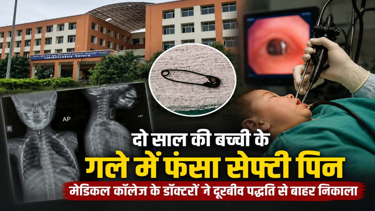 दो साल की बच्ची के गले में फंसा सेफ्टी पिन, मेडिकल कॉलेज के डॉक्टरों ने दूरबीन पद्धति से निकालकर बचाई जान