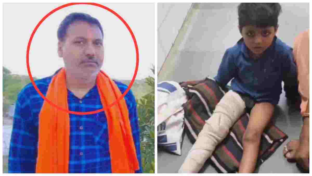 शिक्षा के मंदिर में शिक्षक की हैवानियत: बैग न लाने पर 5 साल के मासूम को जमीन पर पटका, टूटी जांघ की हड्डी, बच्चे के पैर में डली रॉड