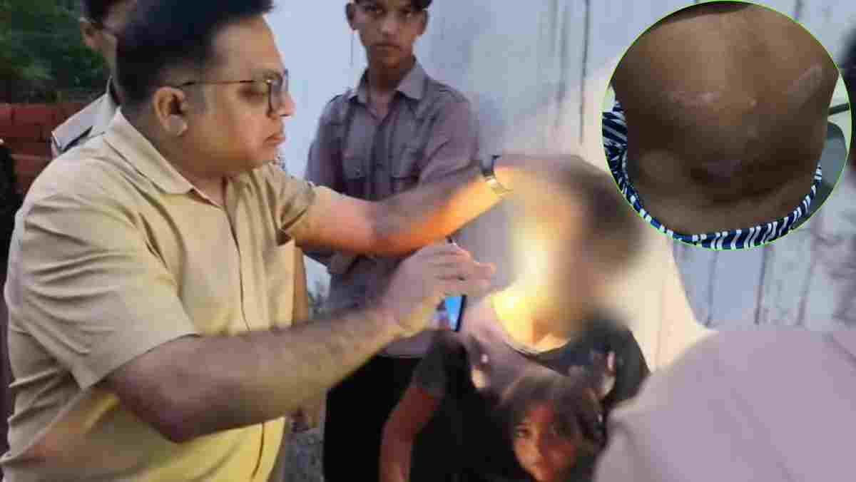 शरीर पर जख्म… जुबां पर दर्द: UP से भागकर शहडोल पहुंची 7 साल की मासूम, डॉक्टर दंपत्ति पर प्रताड़ना कर गर्म चिमटे से दागने का आरोप