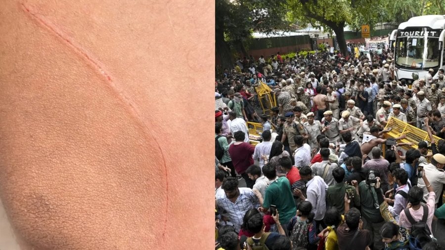 NSUI प्रदर्शन में CAPF जवान पर चाकू से हमला, SIR विवाद के बीच दिल्ली में बढ़ा तनाव